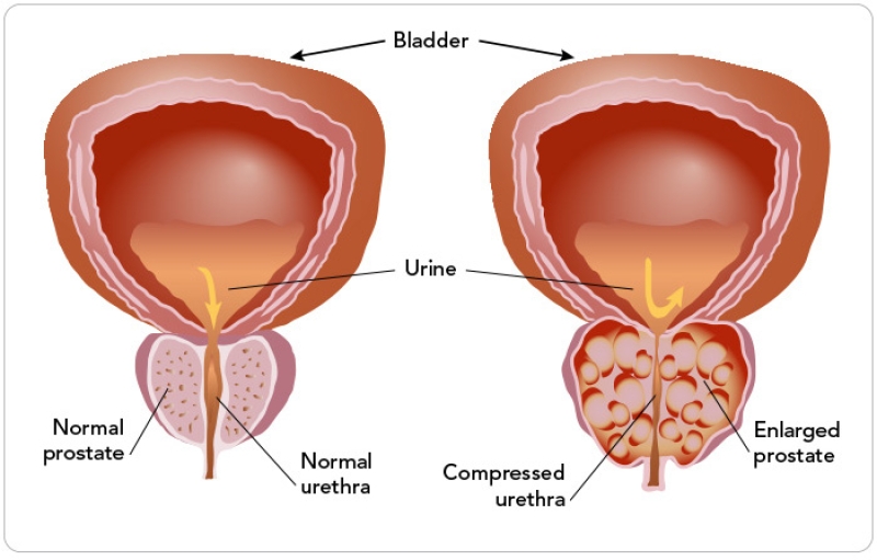 illustration of benign prostatic hyperplasia versus no hyperplasia