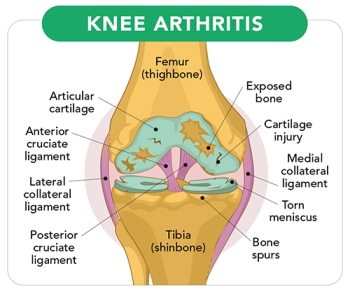 diagram of knee arthritis 