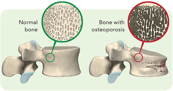 diagram showing a normal bone and an osteoporosis bone