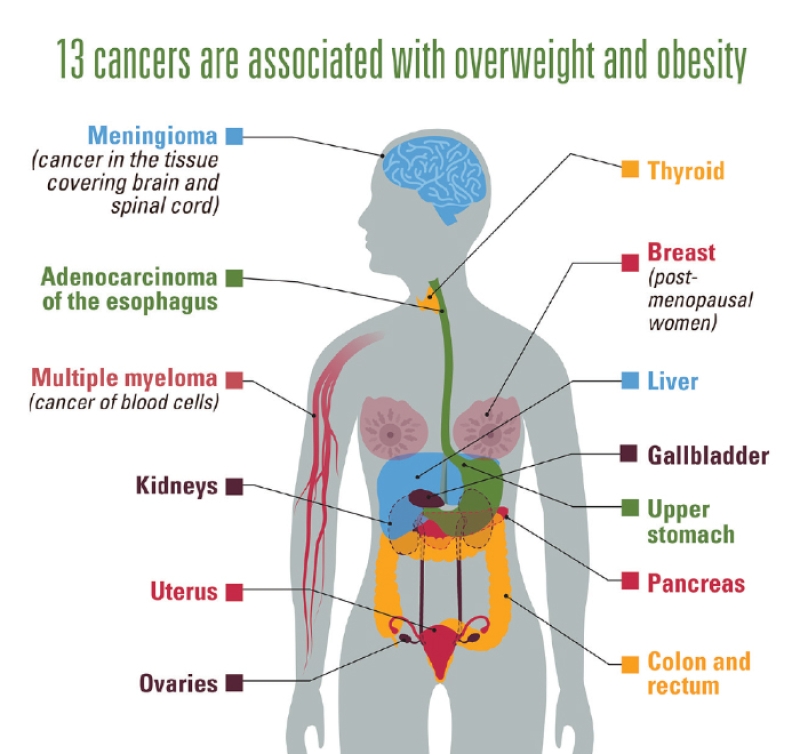cancers associated with overweight and obesity