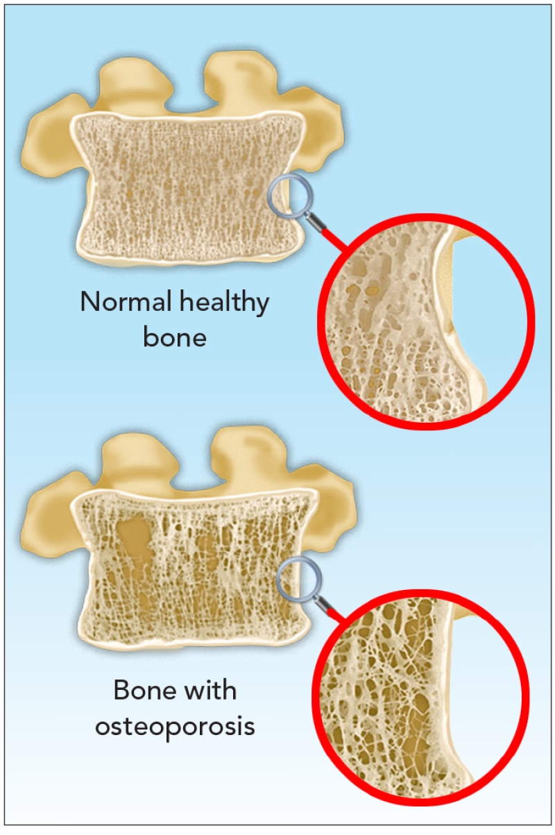 a normal bone and a bone with osteoporosis