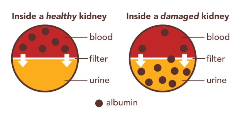 healthy and damaged kidneys