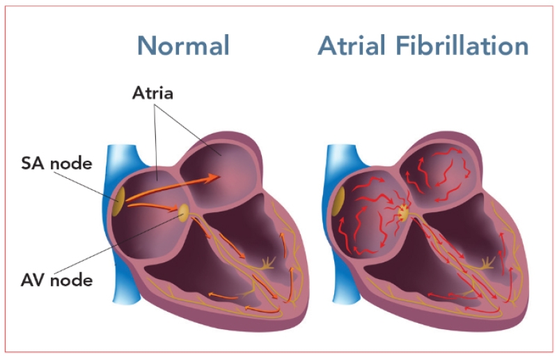 diagram of atrial fibrillation