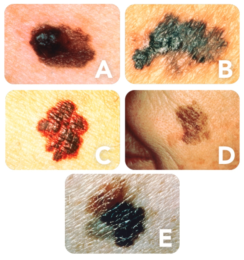 5 examples of melanoma