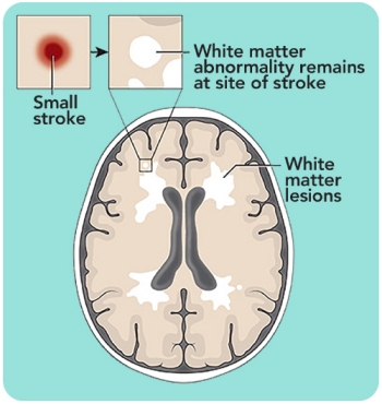 diagram of white matter in the brain